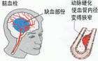 经颅磁刺激康复治疗仪—脑血栓发生的5大前兆 