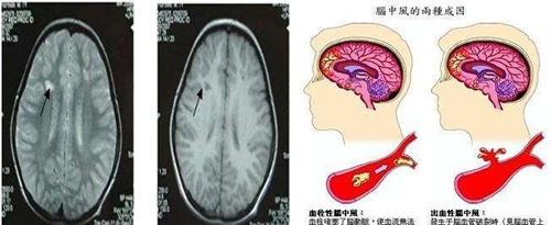 脑血栓症状有哪些症状，脑血栓都有什么症状