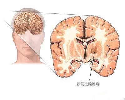 重复经颅磁刺激(rTMS)治疗-癫痫病是什么症状