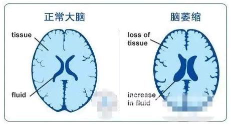 家用经颅磁治疗仪 患有脑萎缩能康复吗