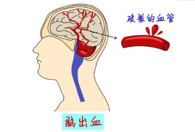 择思达斯经颅磁|脑出血病人能够完全康复么 