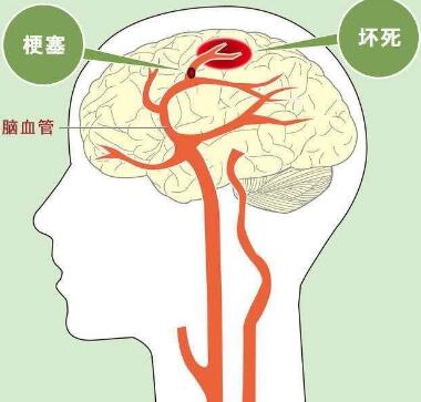 经颅磁刺激仪有什么功效?脑血栓有什么后遗症