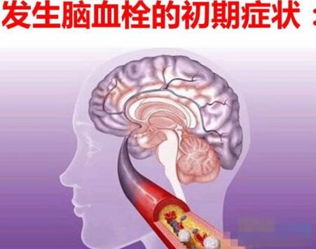 经颅磁刺激仪家用的_脑血栓复发的诱因有哪些 